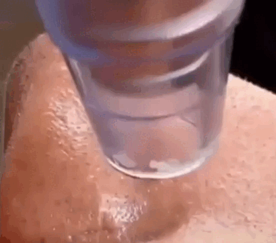 Blackhead Pro Extractor Diario Fácil